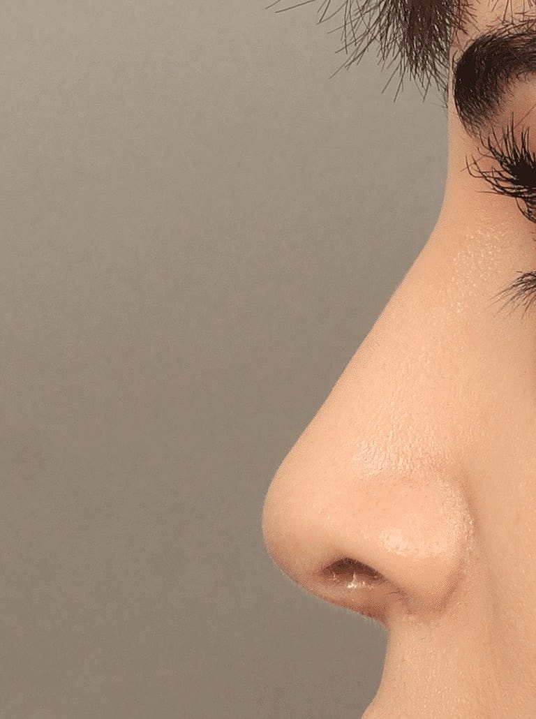 Alarplasty Nostril Reduction Before & After