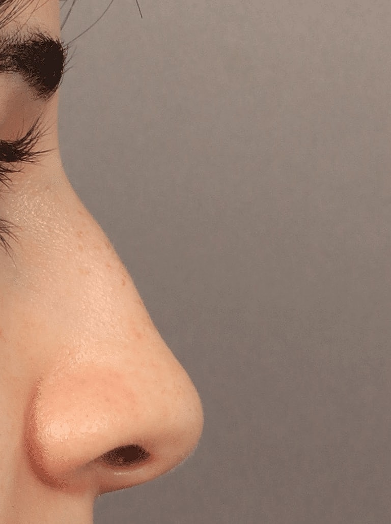 Alarplasty Nostril Reduction Before & After