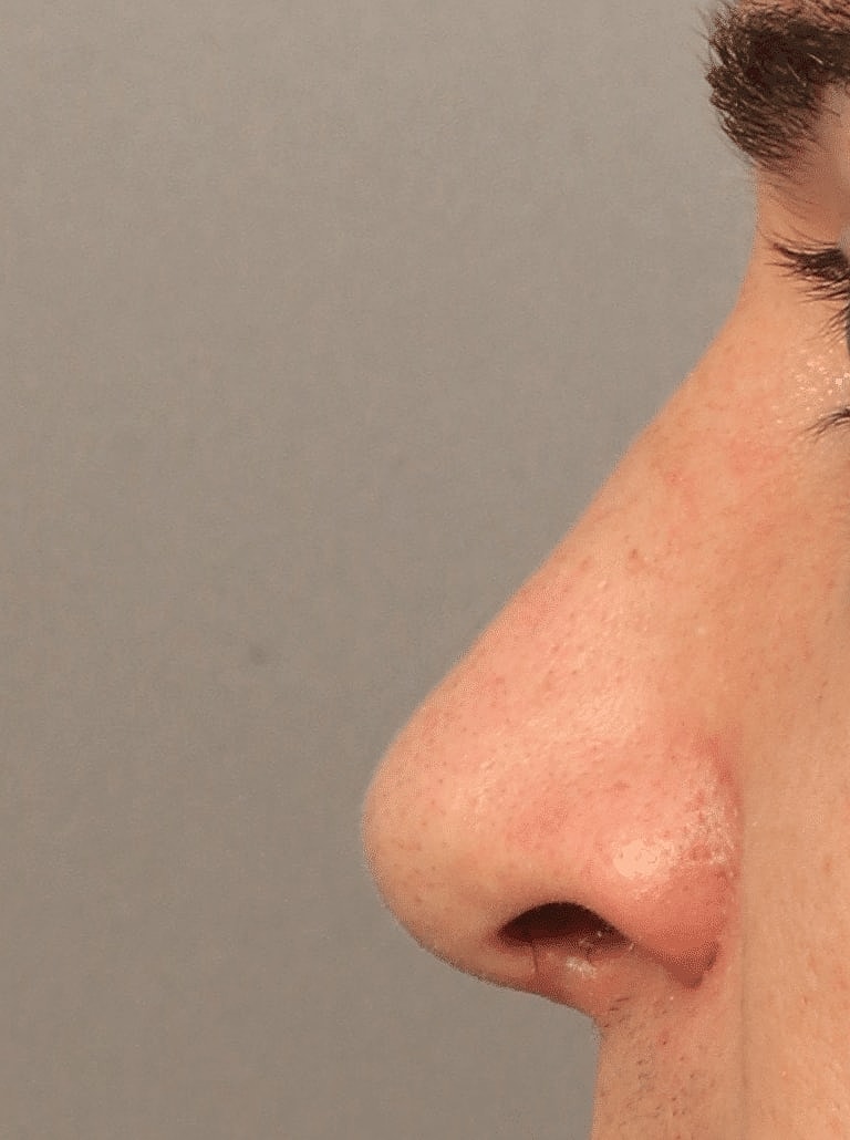 Alarplasty Nostril Reduction Before & After