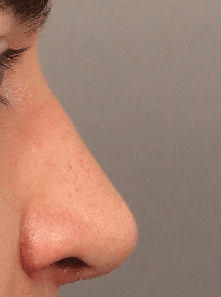 Alarplasty Nostril Reduction Before & After