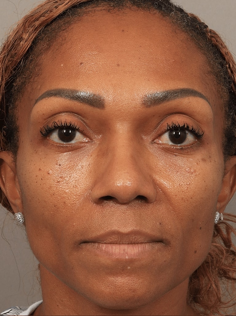 Alarplasty Nostril Reduction Before & After