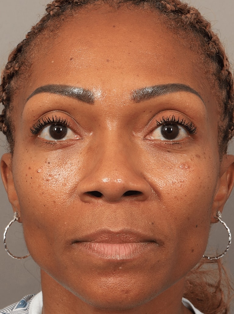 Alarplasty Nostril Reduction Before & After