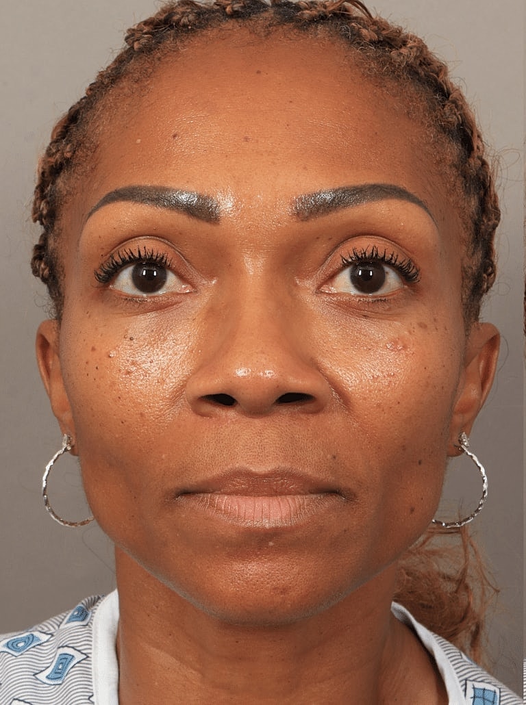 Alarplasty Nostril Reduction Before & After