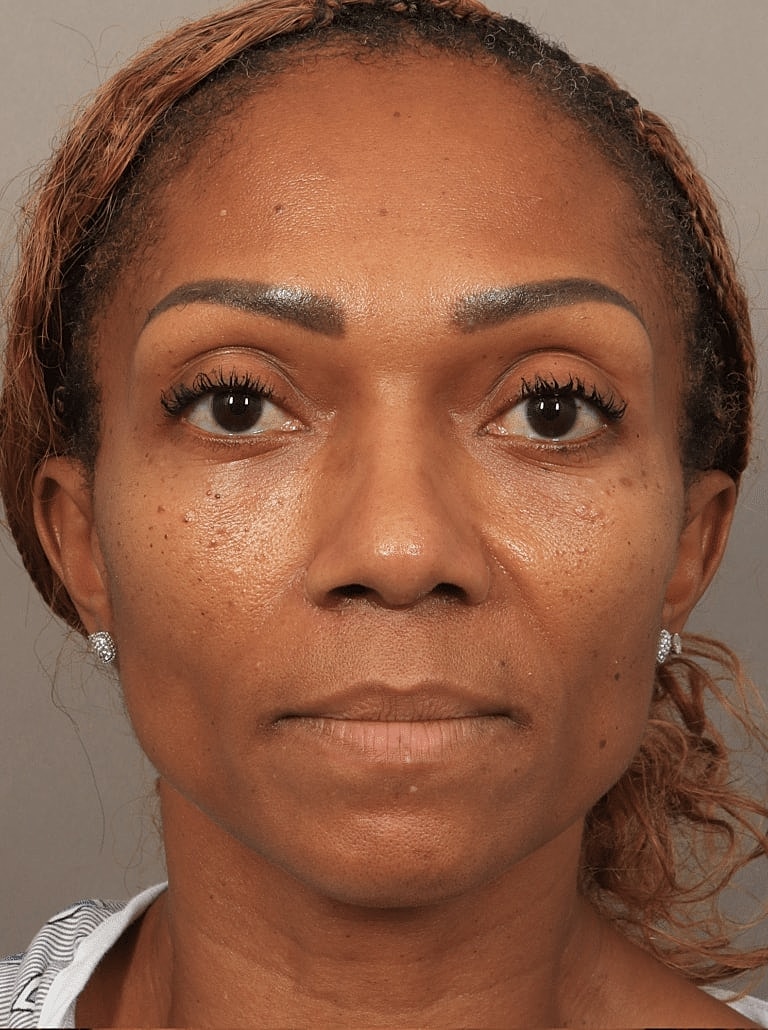 Alarplasty Nostril Reduction Before & After