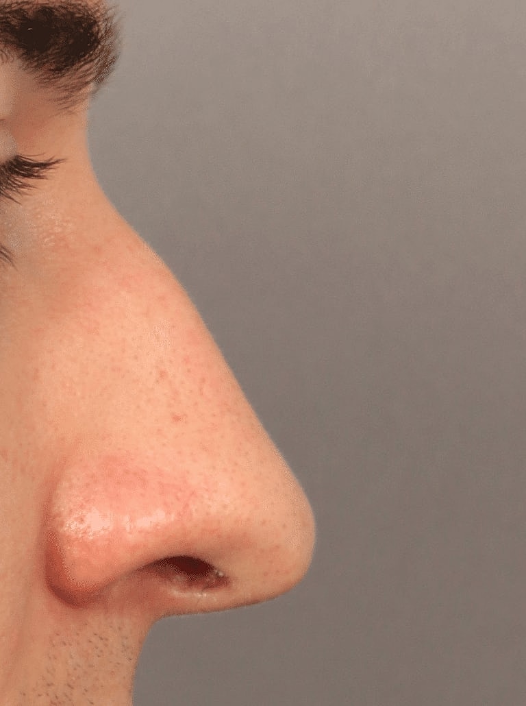 Alarplasty Nostril Reduction Before & After