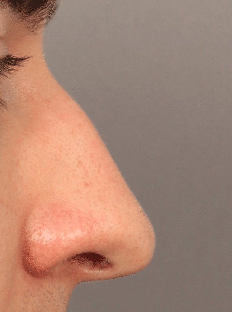 Alarplasty Nostril Reduction Before & After