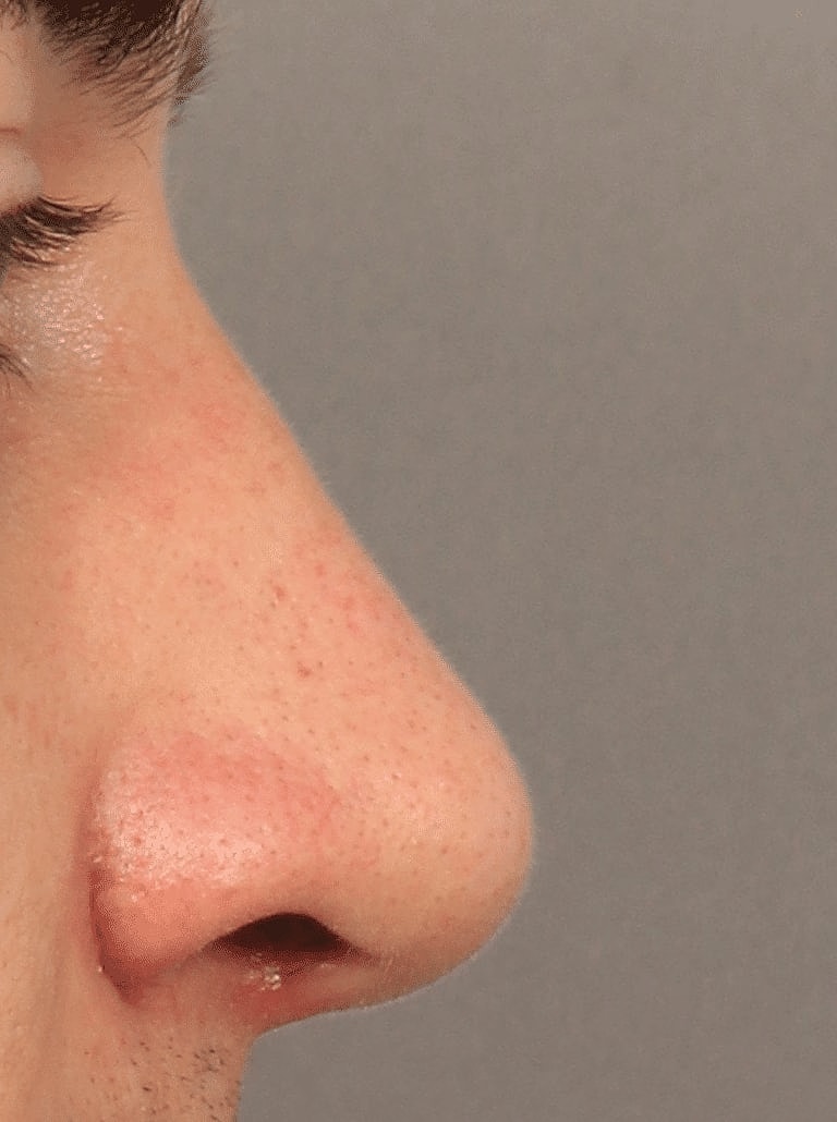 Alarplasty Nostril Reduction Before & After