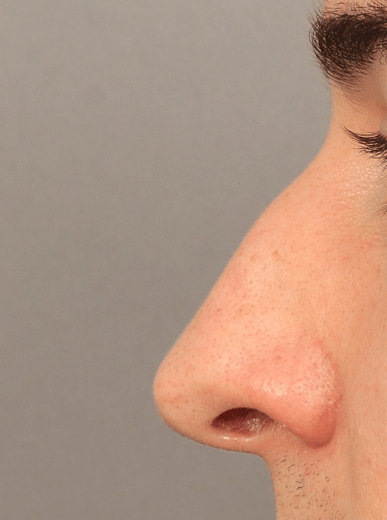 Alarplasty Nostril Reduction Before & After