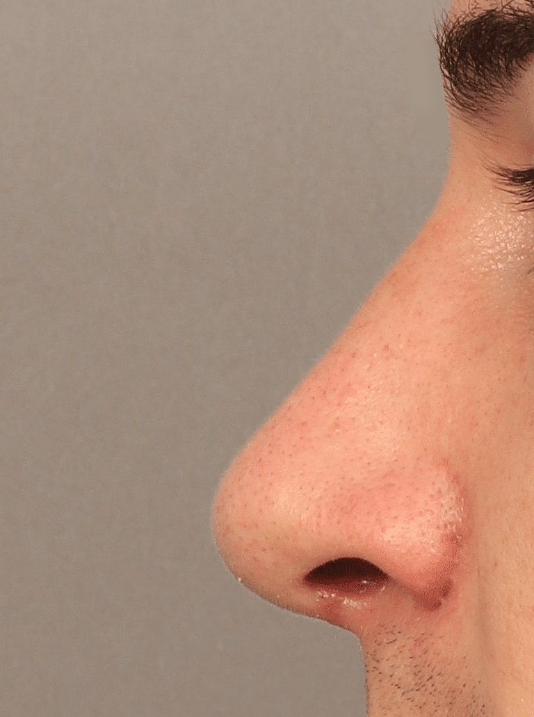 Alarplasty Nostril Reduction Before & After