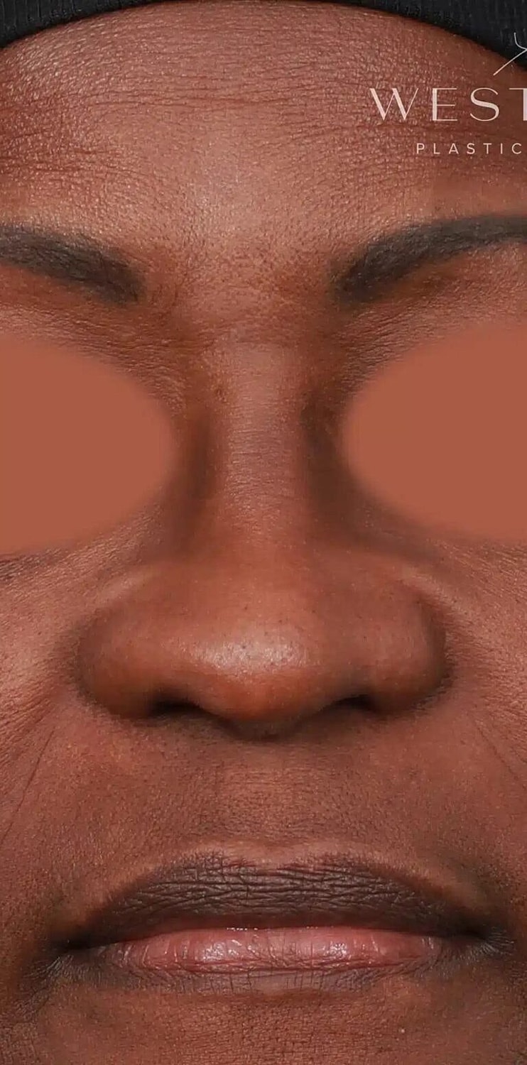 Alarplasty Nostril Reduction Before & After