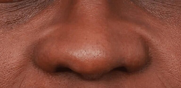 Alarplasty Nostril Reduction Before & After
