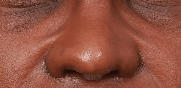 Alarplasty Nostril Reduction Before & After