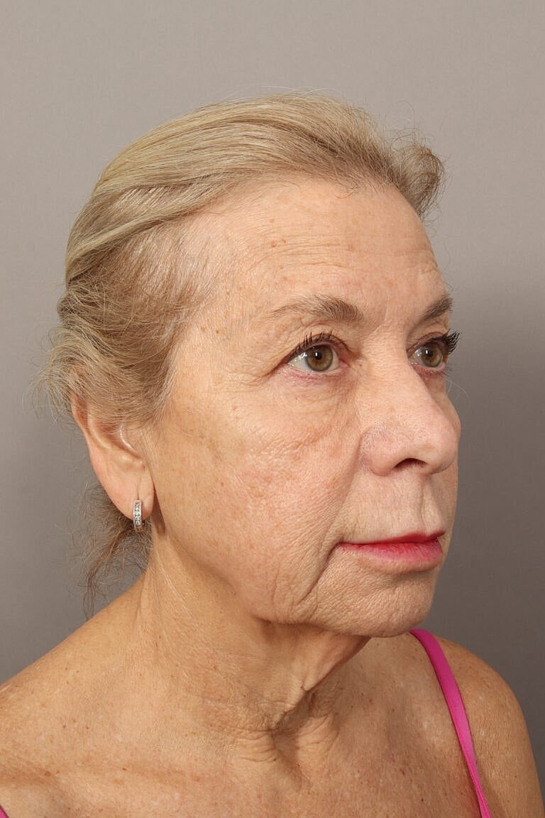 Facelift Before & After