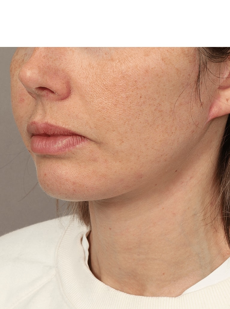 Facelift Before & After