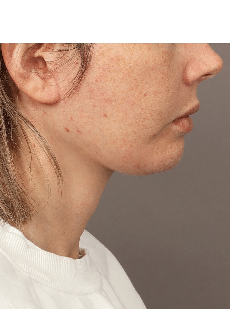 Facelift Before & After