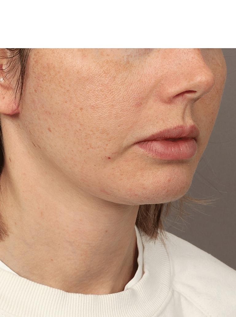 Facelift Before & After
