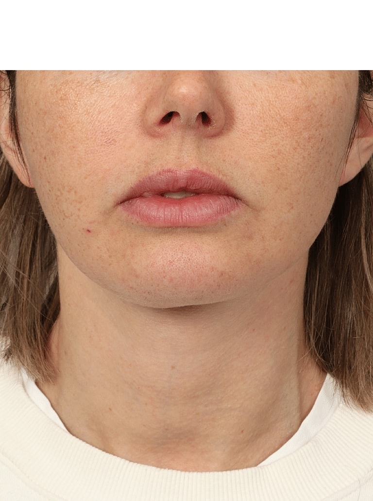 Facelift Before & After