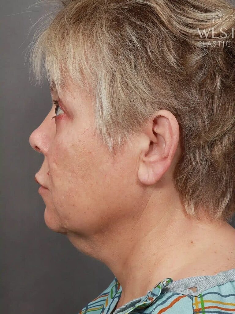 Facelift Before & After