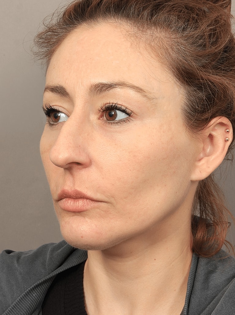 Facelift Before & After