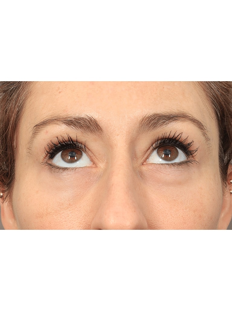 Facelift Before & After