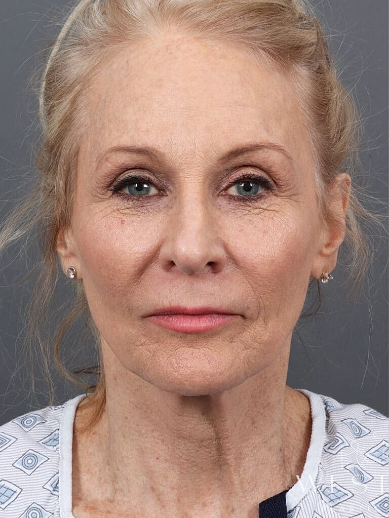 Facelift Before & After