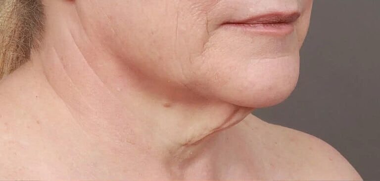 Facelift Before & After