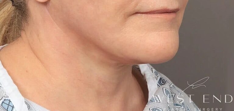 Facelift Before & After