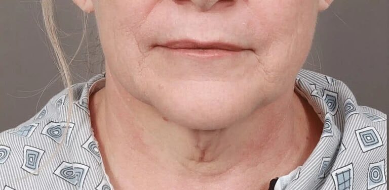 Facelift Before & After
