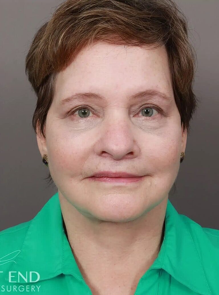 Facelift Before & After