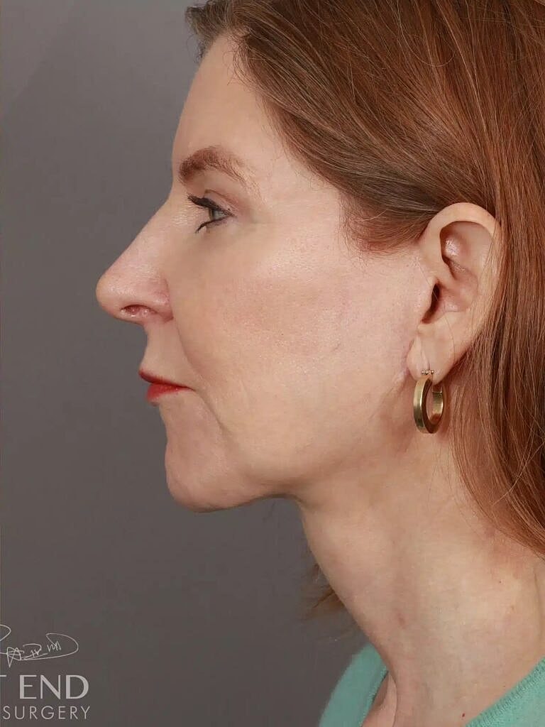 Facelift Before & After