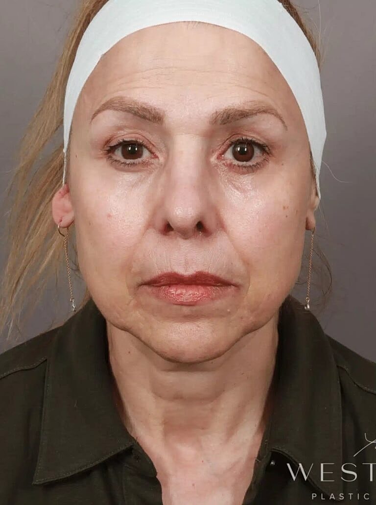 Facelift Before & After