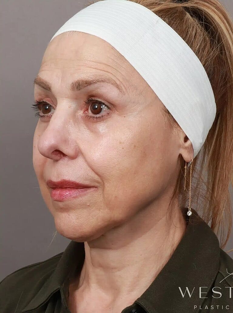 Facelift Before & After