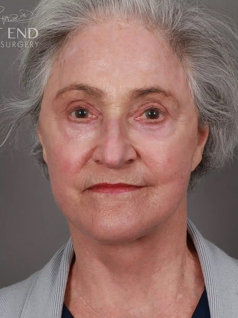 Facelift Before & After