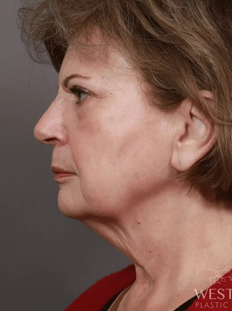 Facelift Before & After