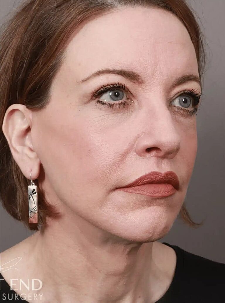 Facelift Before & After