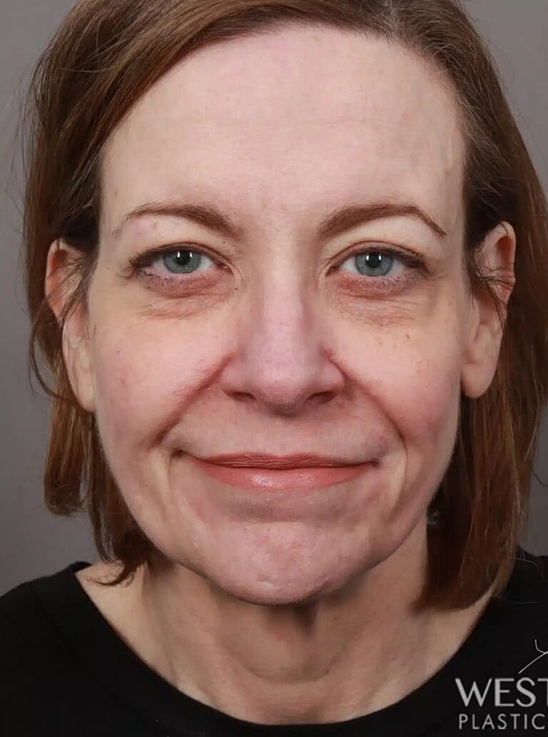 Facelift Before & After