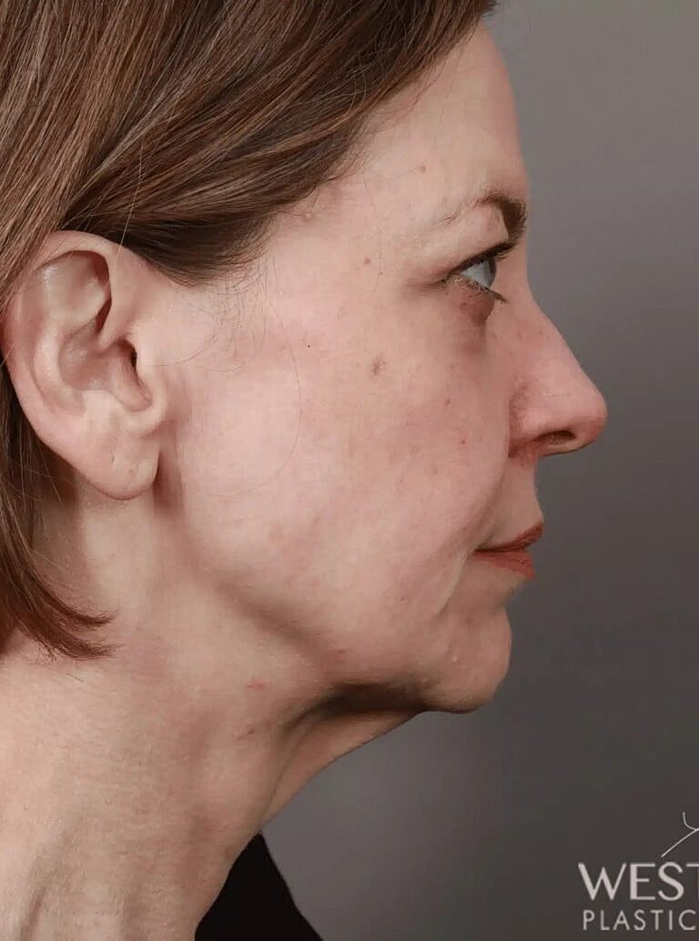 Facelift Before & After