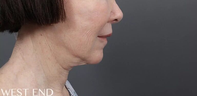 Facelift Before & After