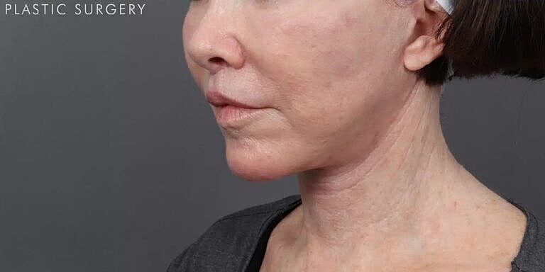 Facelift Before & After