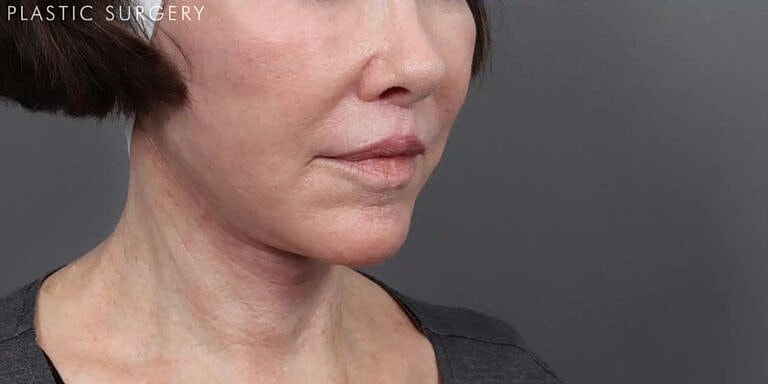 Facelift Before & After