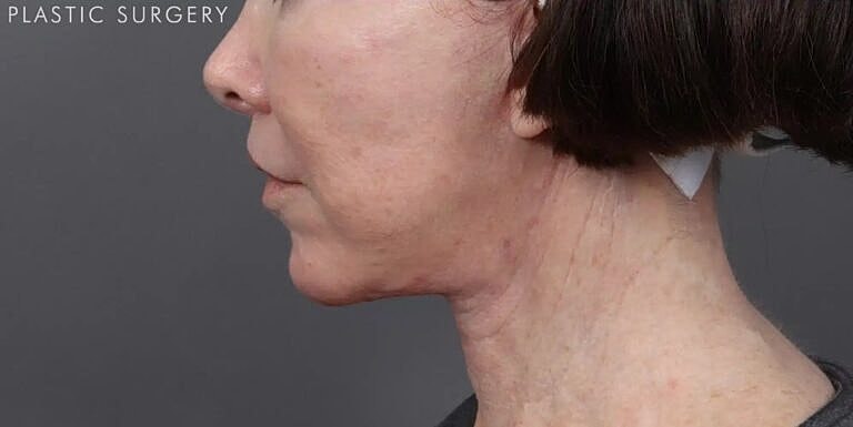 Facelift Before & After