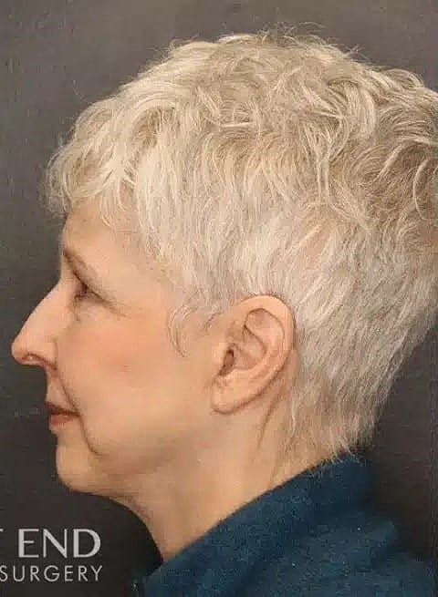 Facelift Before & After