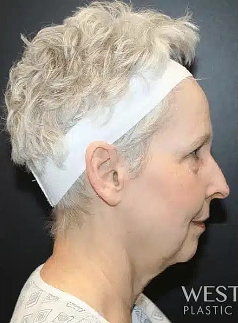 Facelift Before & After