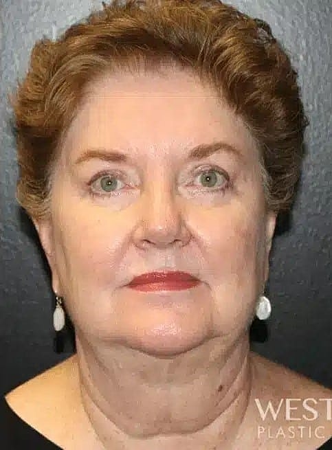 Facelift Before & After