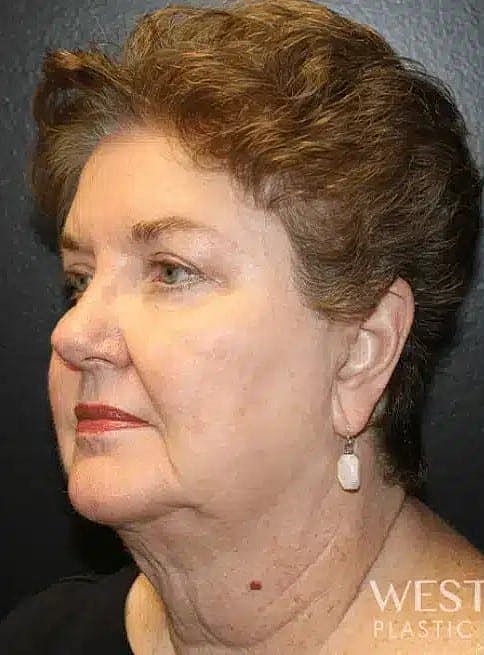Facelift Before & After