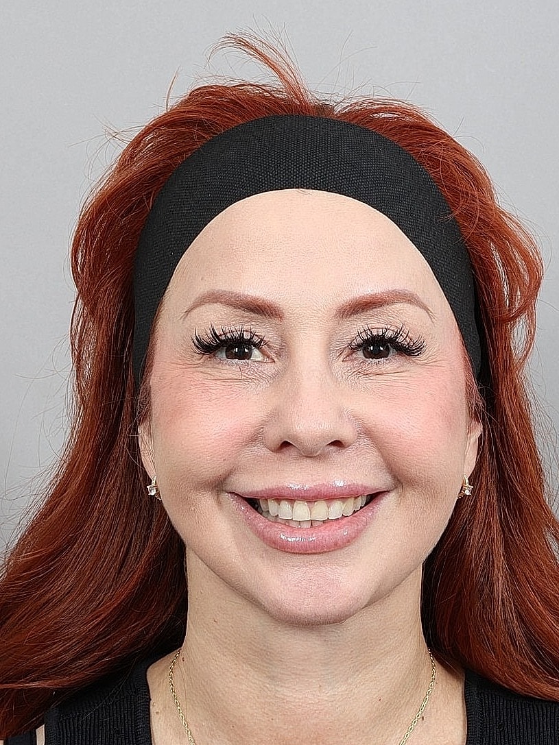 Facelift Before & After