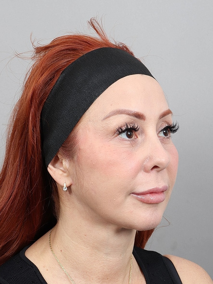 Facelift Before & After
