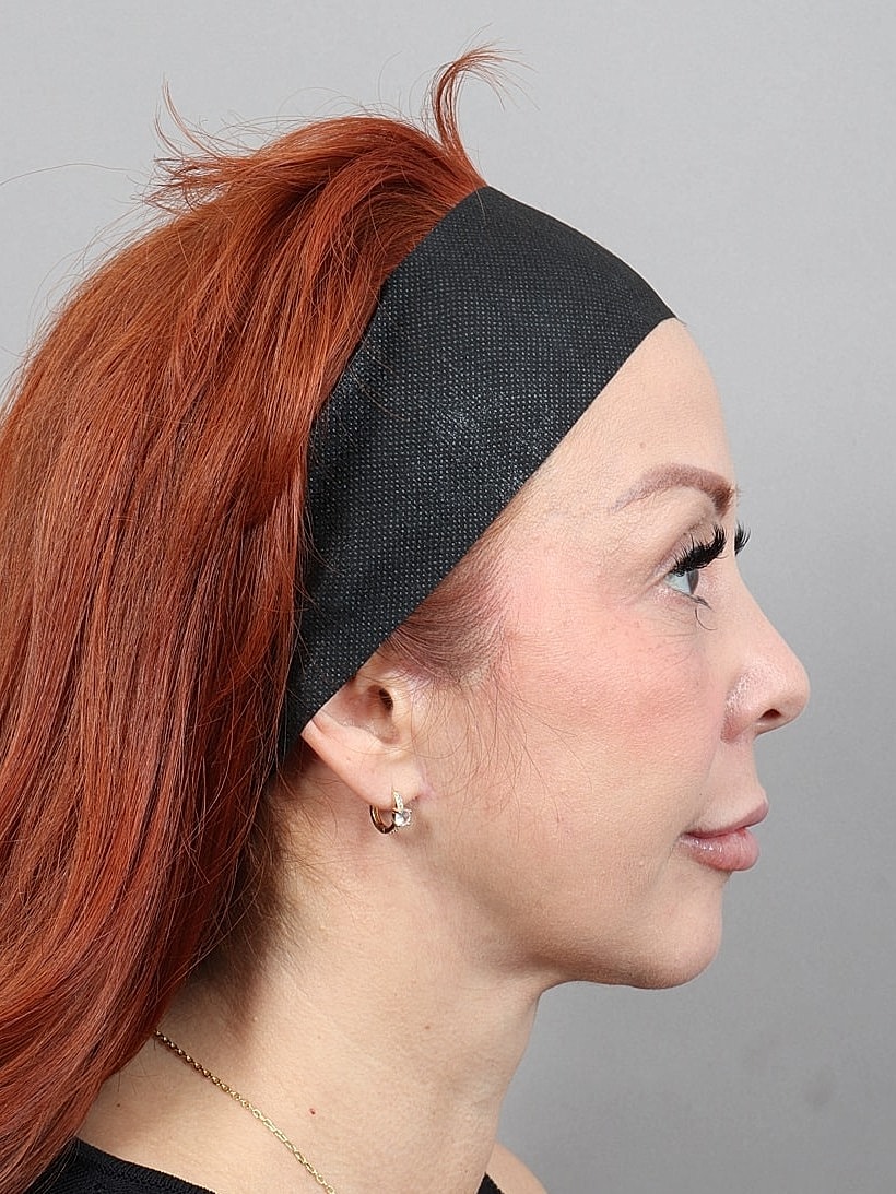 Facelift Before & After