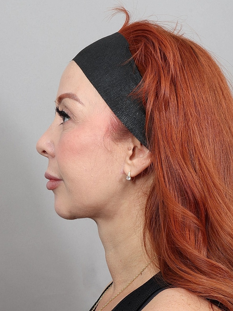 Facelift Before & After