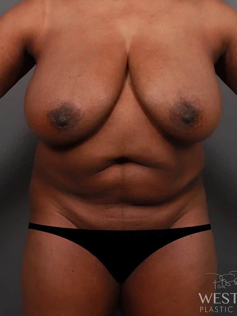 Breast Reduction Before & After